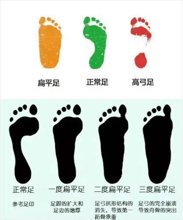 平足孩子如何买鞋