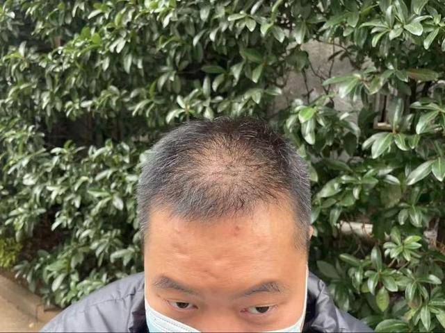 “还能反光<strong></p>
<p>虚拟币FIFA</strong>！”长沙男子植发近9月称后脑勺“像狗啃过”