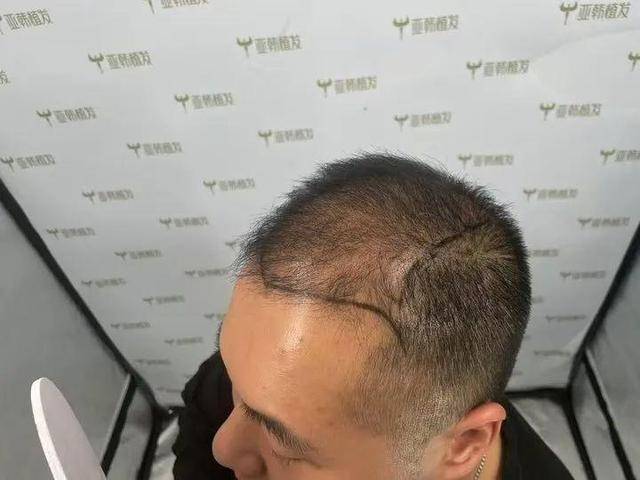 “还能反光<strong></p>
<p>虚拟币FIFA</strong>！”长沙男子植发近9月称后脑勺“像狗啃过”