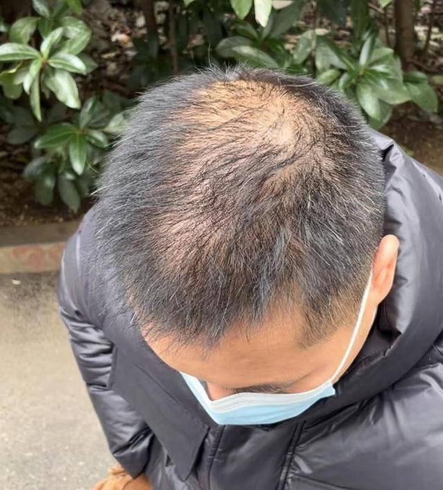 “还能反光<strong></p>
<p>虚拟币FIFA</strong>！”长沙男子植发近9月称后脑勺“像狗啃过”