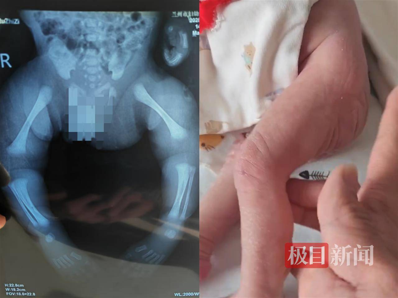 二胎出生查出先天性病症或落下残疾<strong></p>
<p>原油交易规则</strong>，残疾父母称医院产检漏检、未尽告知义务，医院及医调委回应
