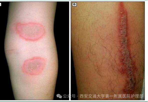 西安多区发现隐翅虫？千万别拍<strong></p>
<p>黄金原油早评</strong>！毒液堪比硫酸