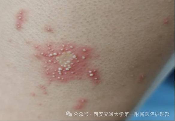 西安多区发现隐翅虫？千万别拍<strong></p>
<p>黄金原油早评</strong>！毒液堪比硫酸