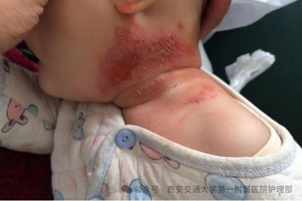 西安多区发现隐翅虫？千万别拍<strong></p>
<p>黄金原油早评</strong>！毒液堪比硫酸