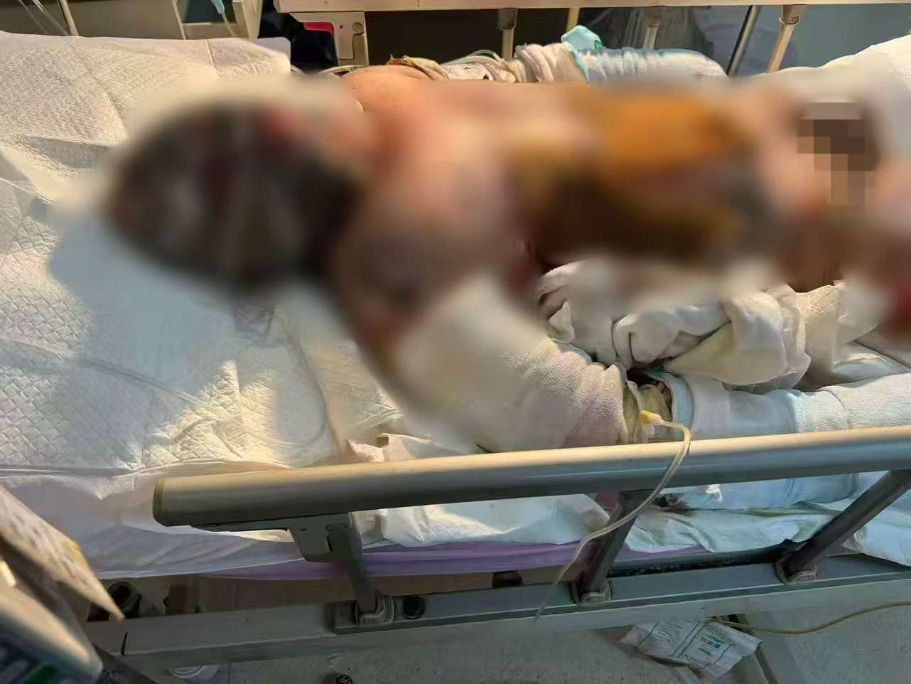 父子在哈尔滨一亲戚公司上班遇爆炸全身烧伤<strong></p>
<p>点差原油</strong>,治疗花费近百万公司拒赔偿?亲戚回应