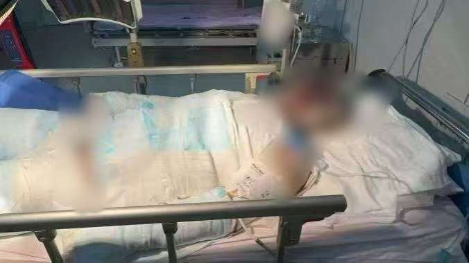 父子在哈尔滨一亲戚公司上班遇爆炸全身烧伤<strong></p>
<p>点差原油</strong>,治疗花费近百万公司拒赔偿?亲戚回应