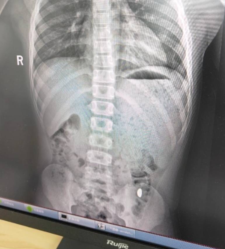 “熊孩子”误吞10克重金豆<strong></p>
<p>中原油田房产</strong>，妈妈：天天叮嘱他不要在外面拉屎