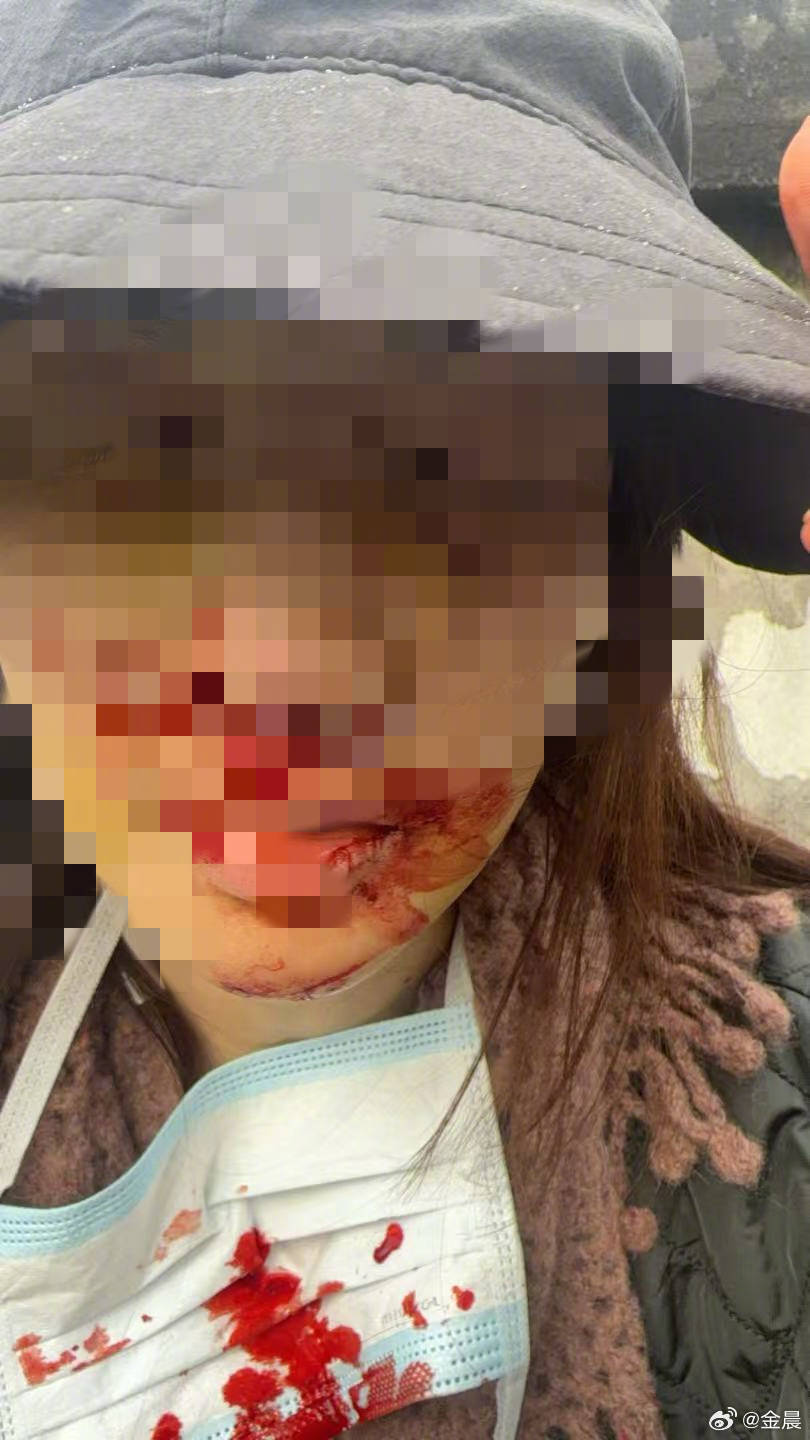 警方发布警情通报后<strong></p>
<p>证券交易结算资金余额</strong>，金晨晒脸部受伤照片并发文道歉